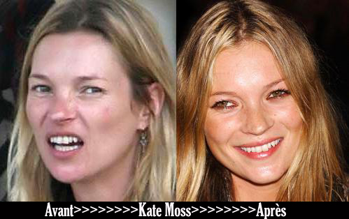 Avant après « Kate Moss »